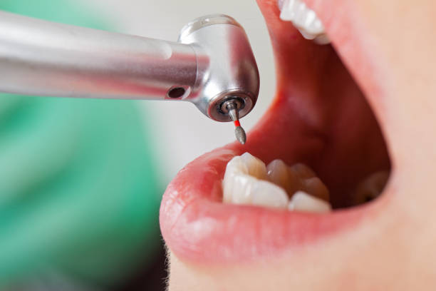 Best Emergency Tooth Extraction in Twin Grove, IL